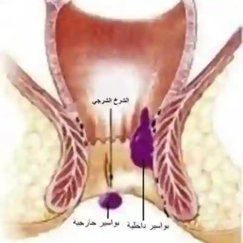 الشرخ الشرجي الشق بالشرج